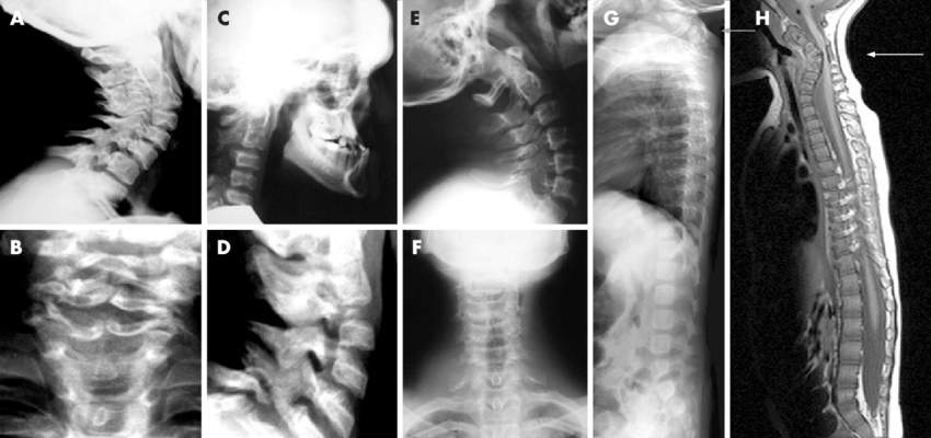 Anomalies of the cervical spine in Larsen syndrome A Cervical kyphosis B D