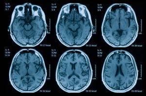 Sinusthrombose 