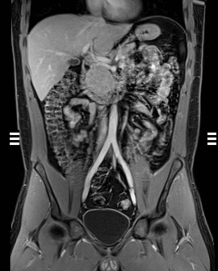 MRT Abdomen Frontalansicht