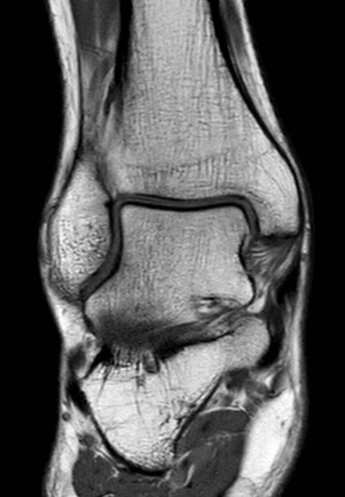 MRT Sprunggelenk Hinteransicht