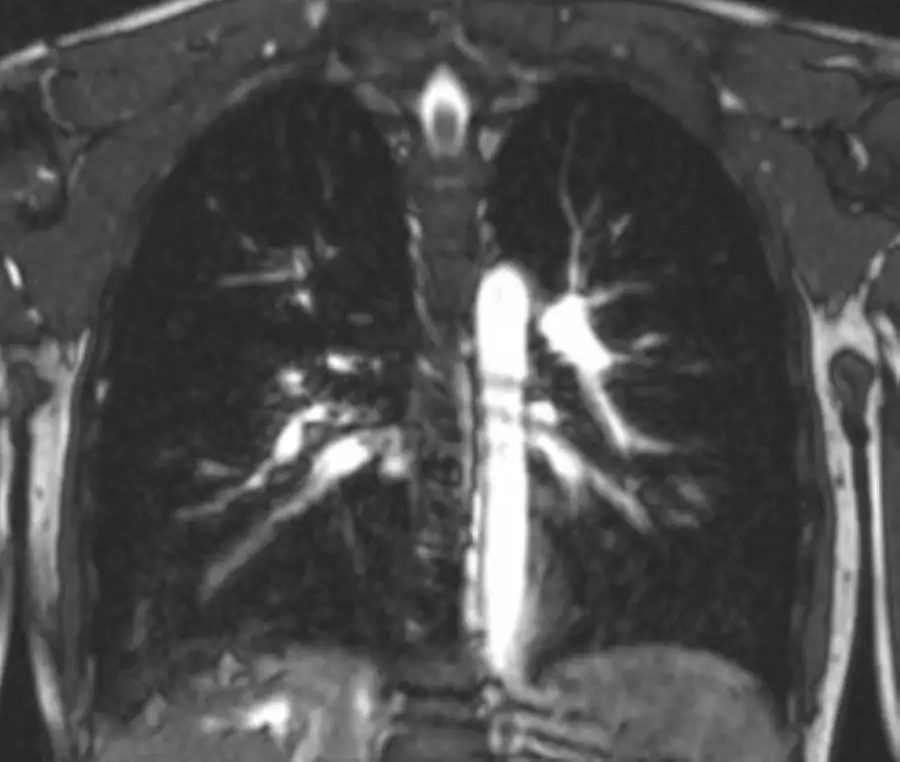 MRTThorax frontal