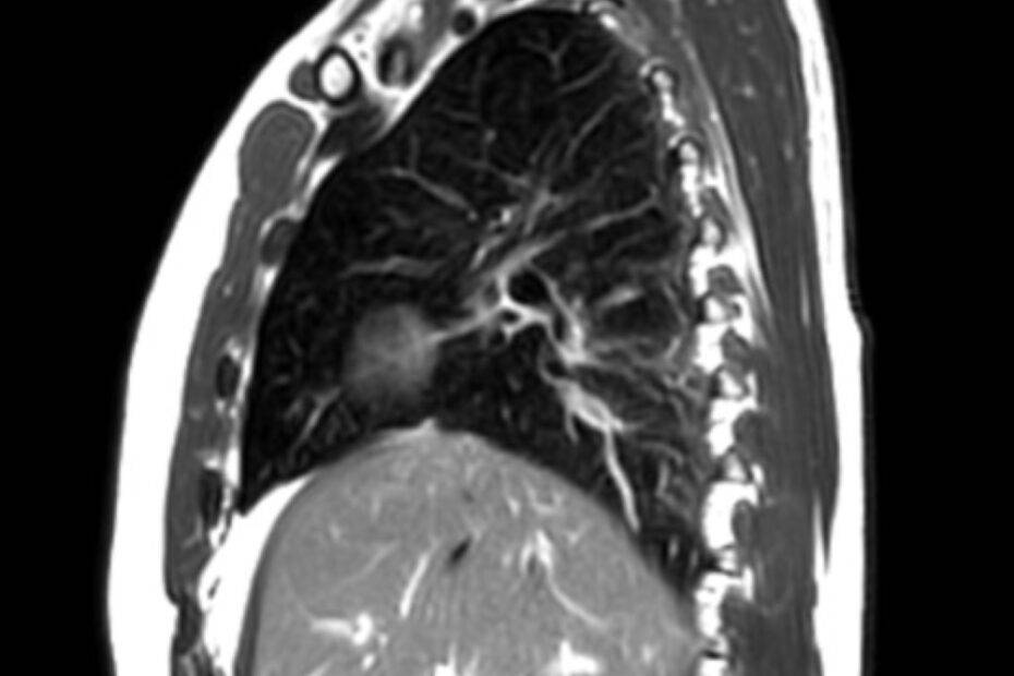 MRTThorax seitlich