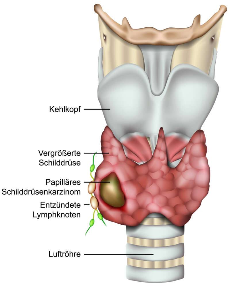 Schilddruesenkrebs