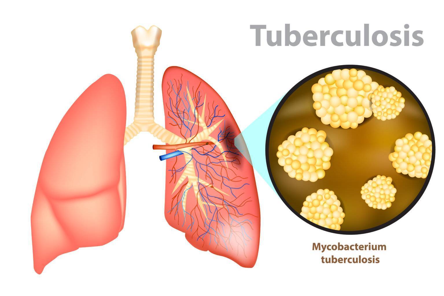 Tuberkulose