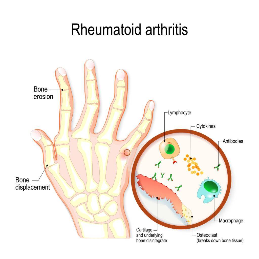 Arthritis 