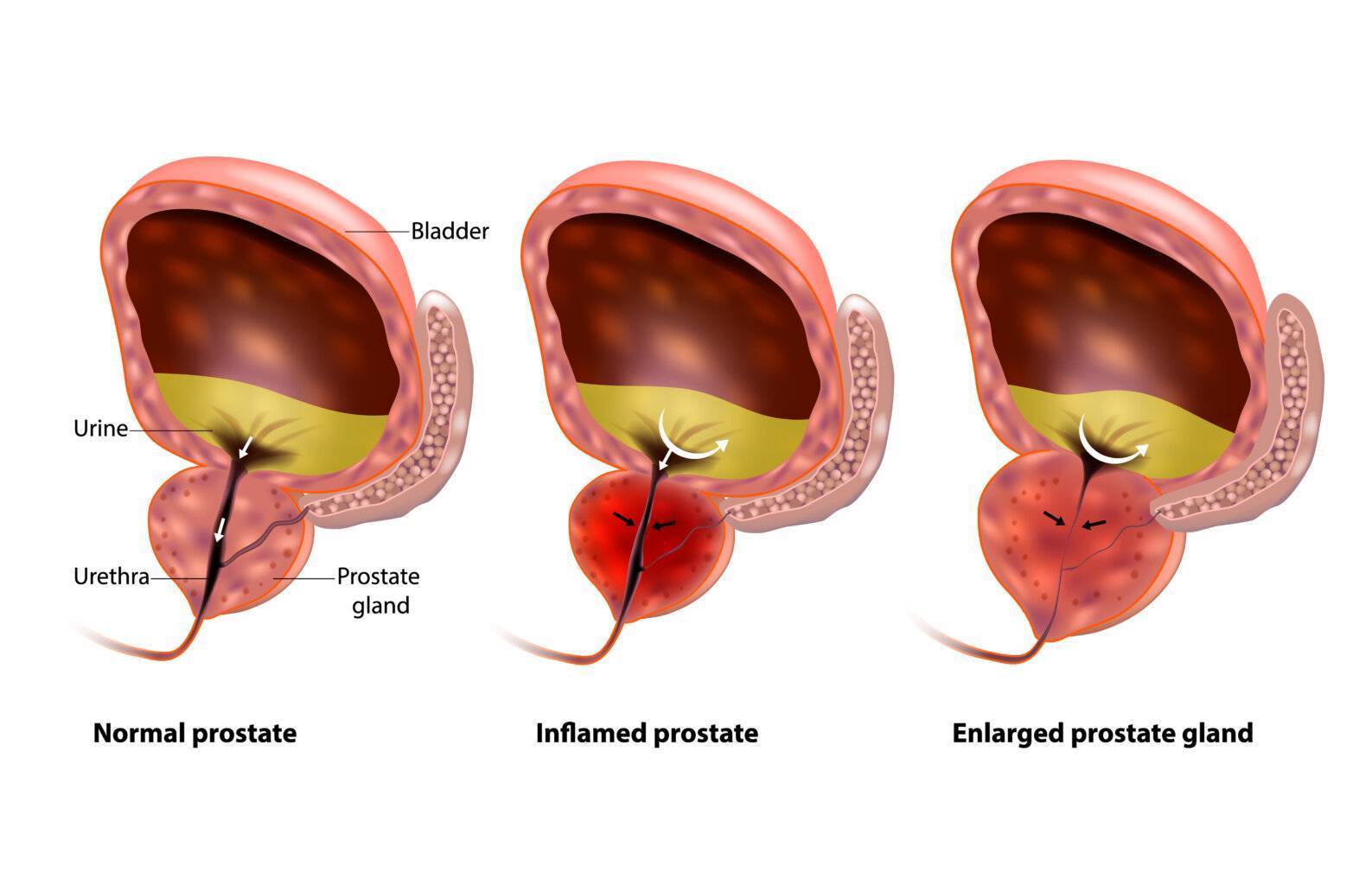 Biopsie Prostata 