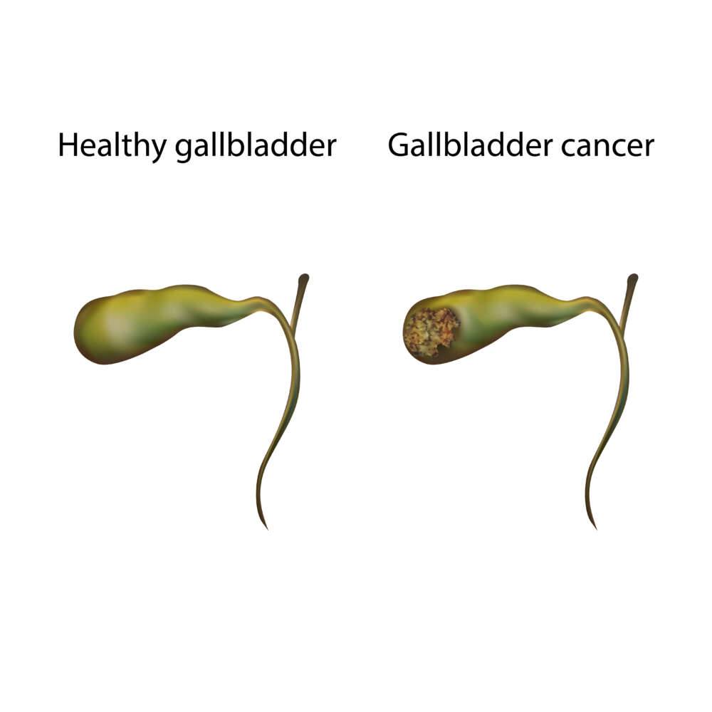 Gallenblasenkrebs