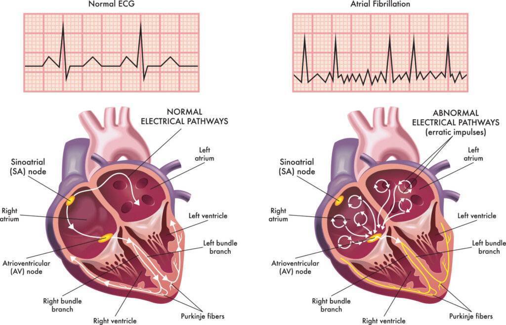 Vorhofflimmern | medneo.com