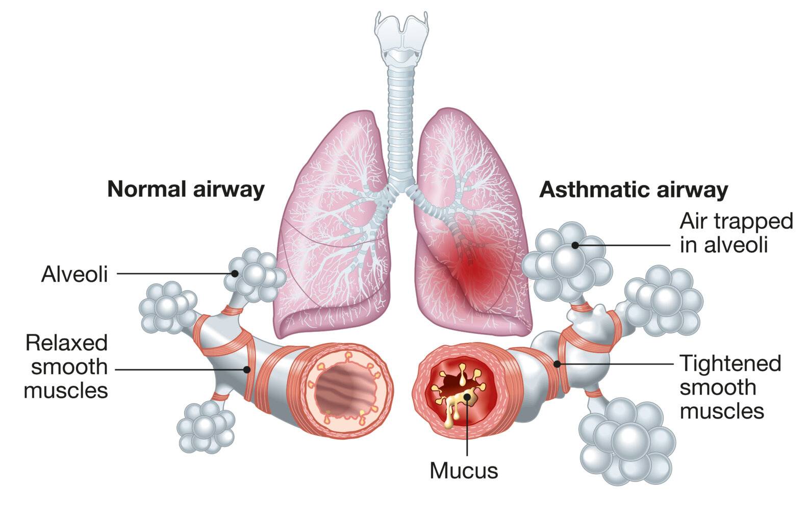 Asthma