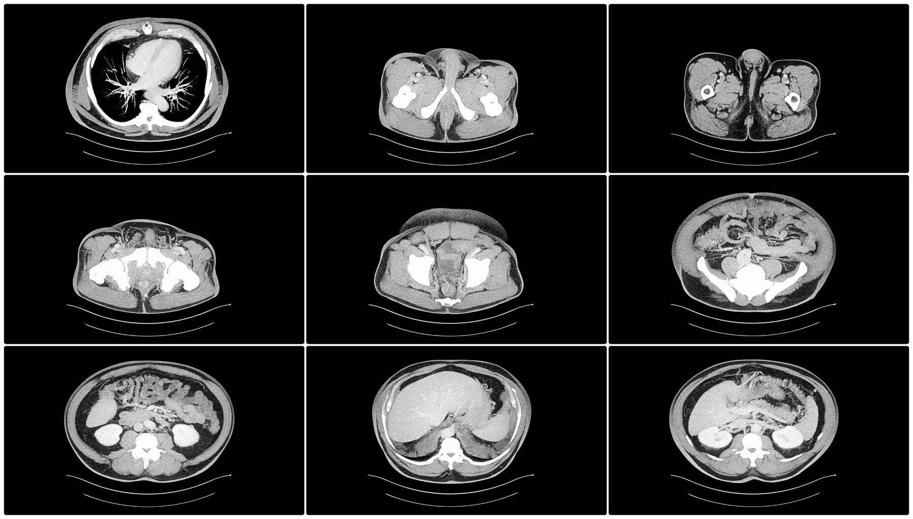 CT Abdomen