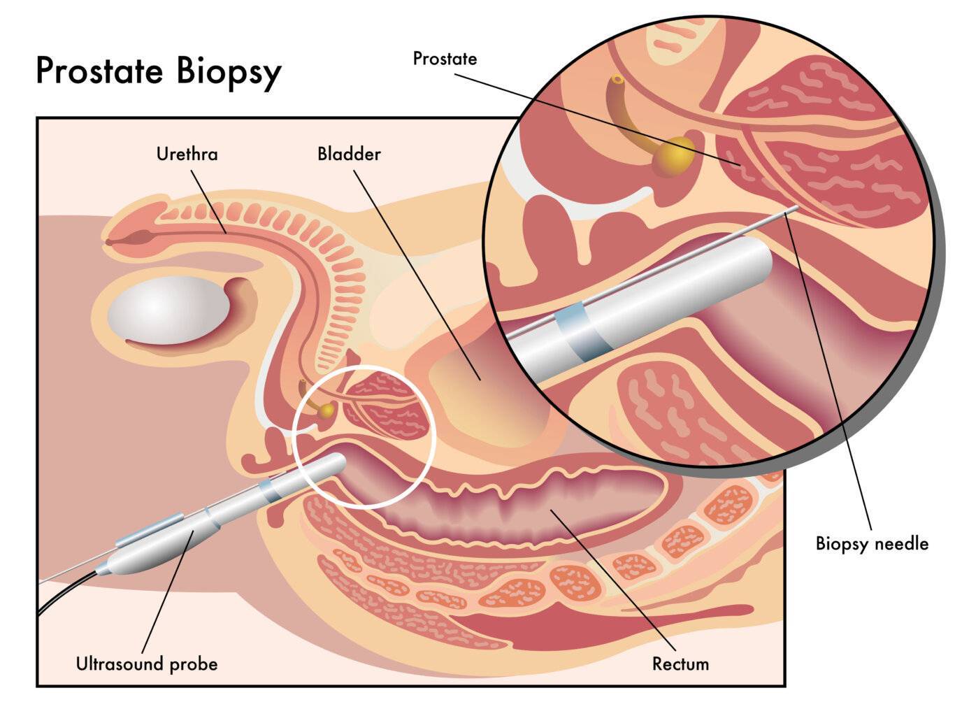Biopsie Prostata
