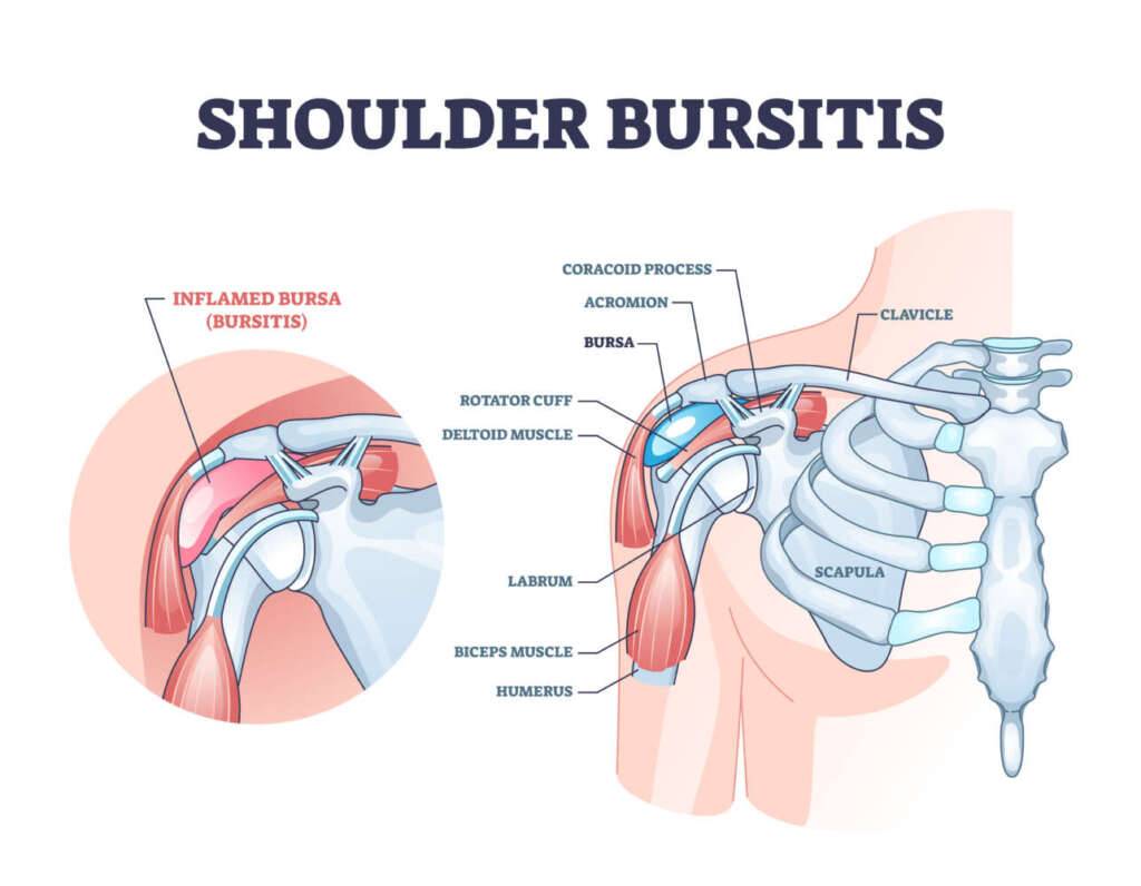 Schulter Bursitis