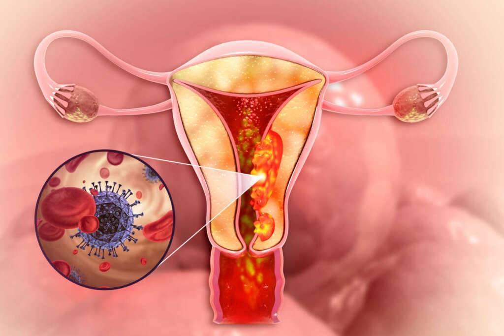 Gebärmutterschleimhautkrebs