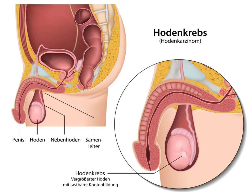 hodenkrebs