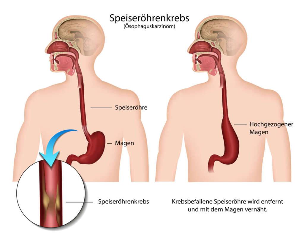 Speiseröhrenkrebs