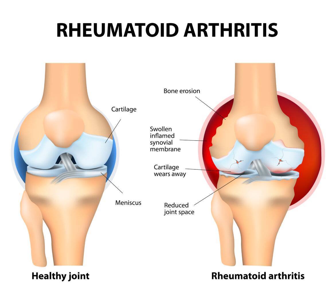 Arthritis