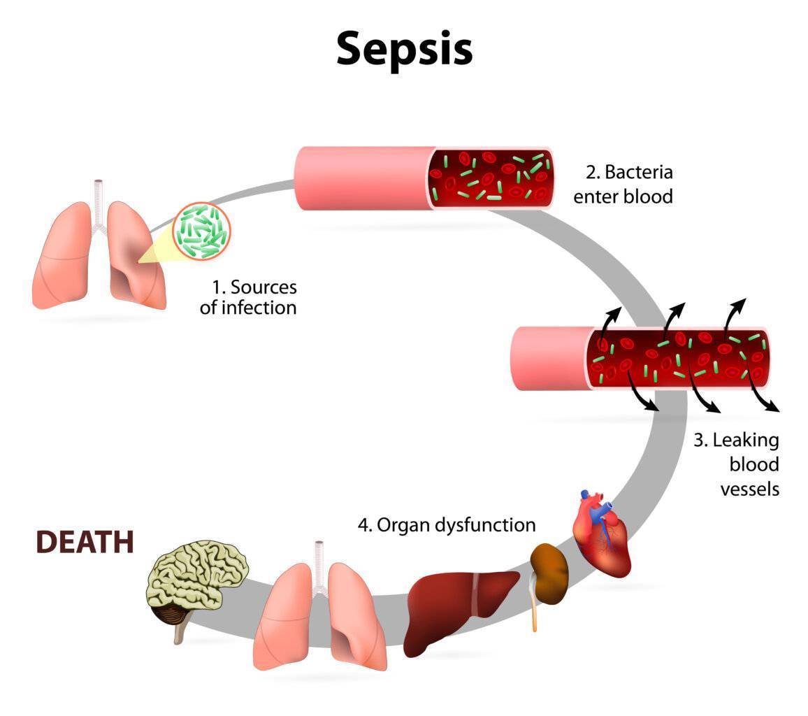 Sepsis