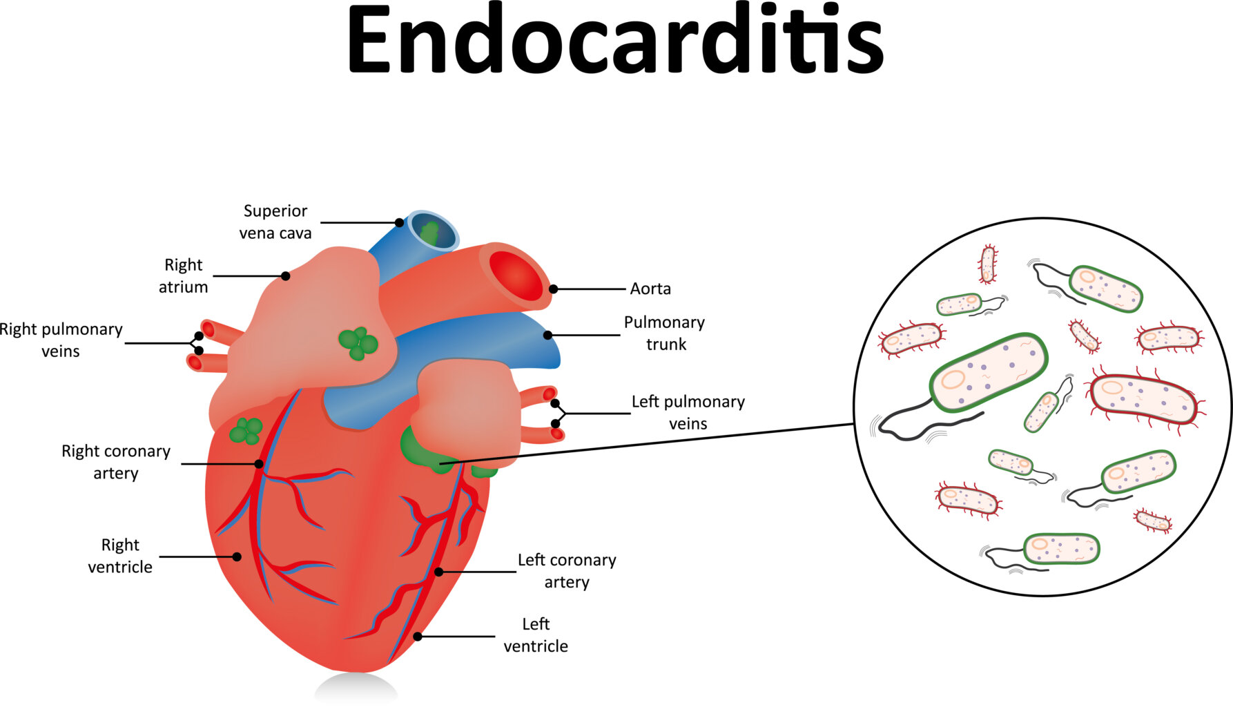 Endokarditis