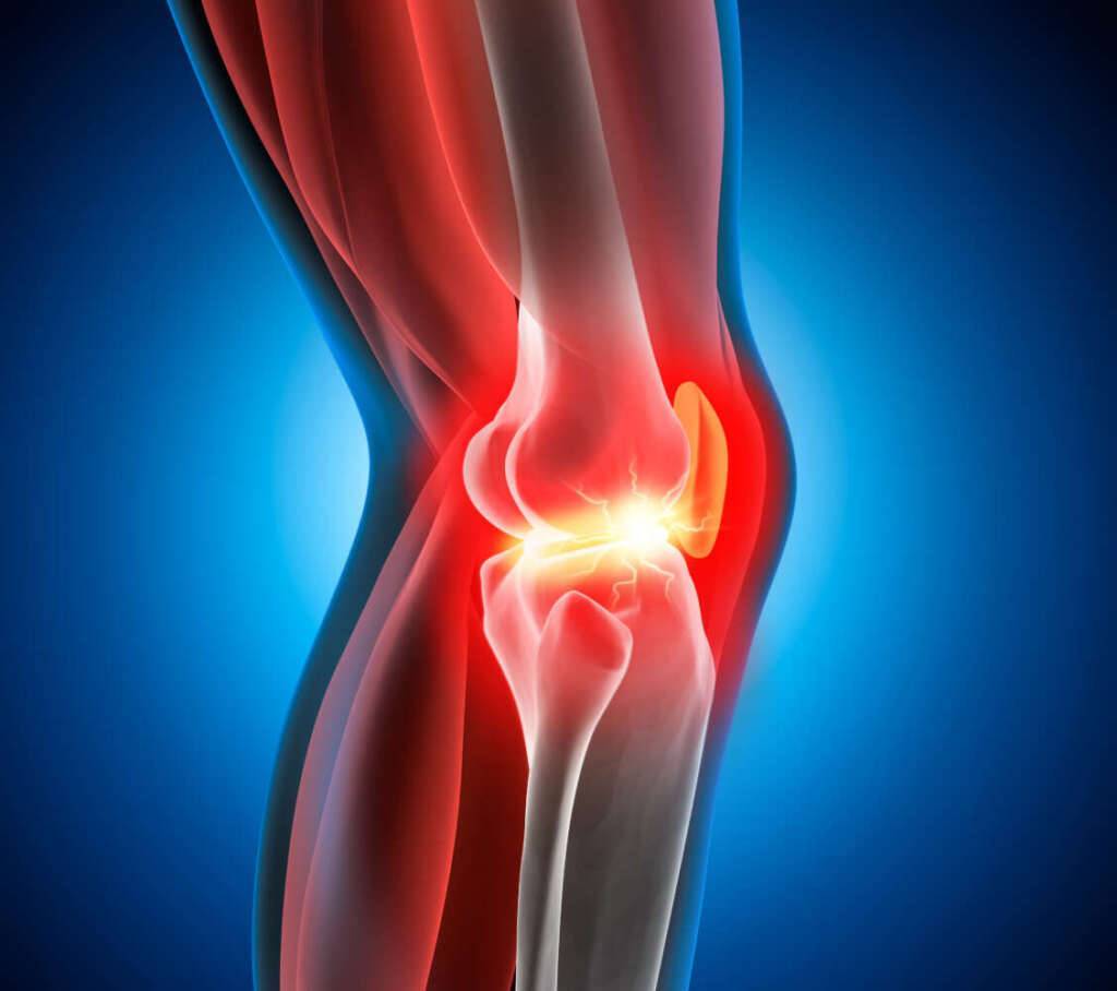Baenderriss am Knie