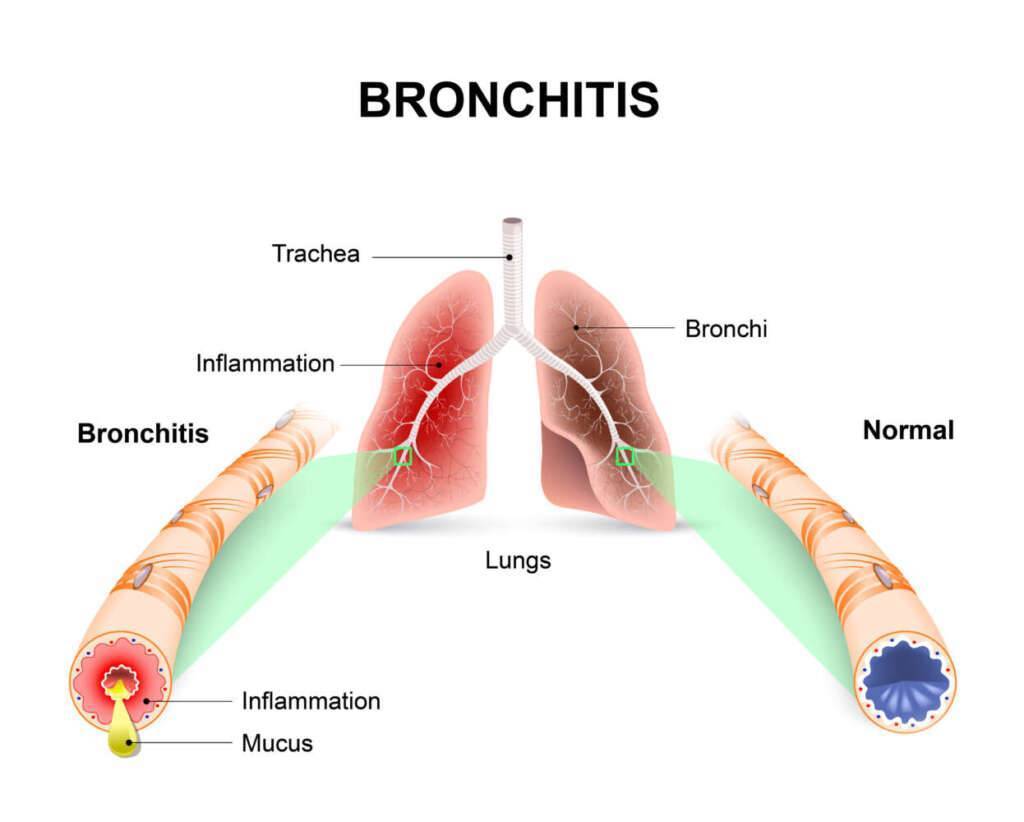 Bronchitis