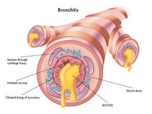 bronchite