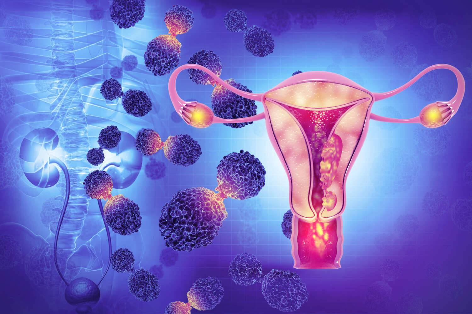 Endometriose Was dahinter steckt und was man tun kann