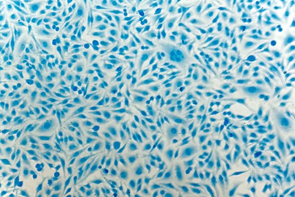 Gebaermutterhalskrebs Zellen