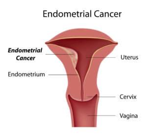 Gebärmutterschleimhautkrebs