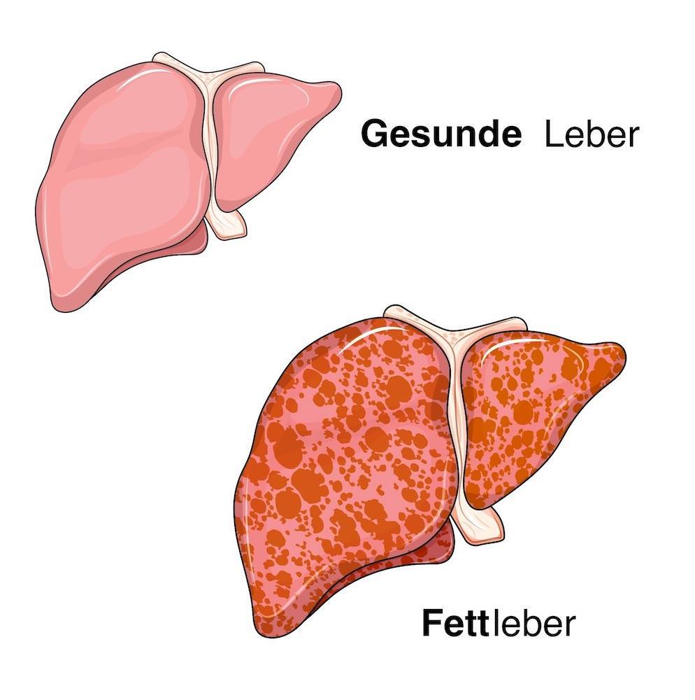 Gesunde Leber Fettleber