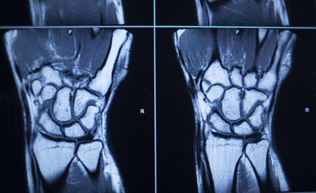 Handgelenksfraktur MRT