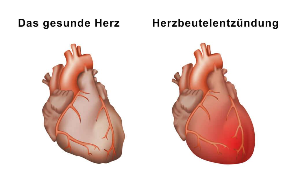 Herzbeutelentzündung pericarditis