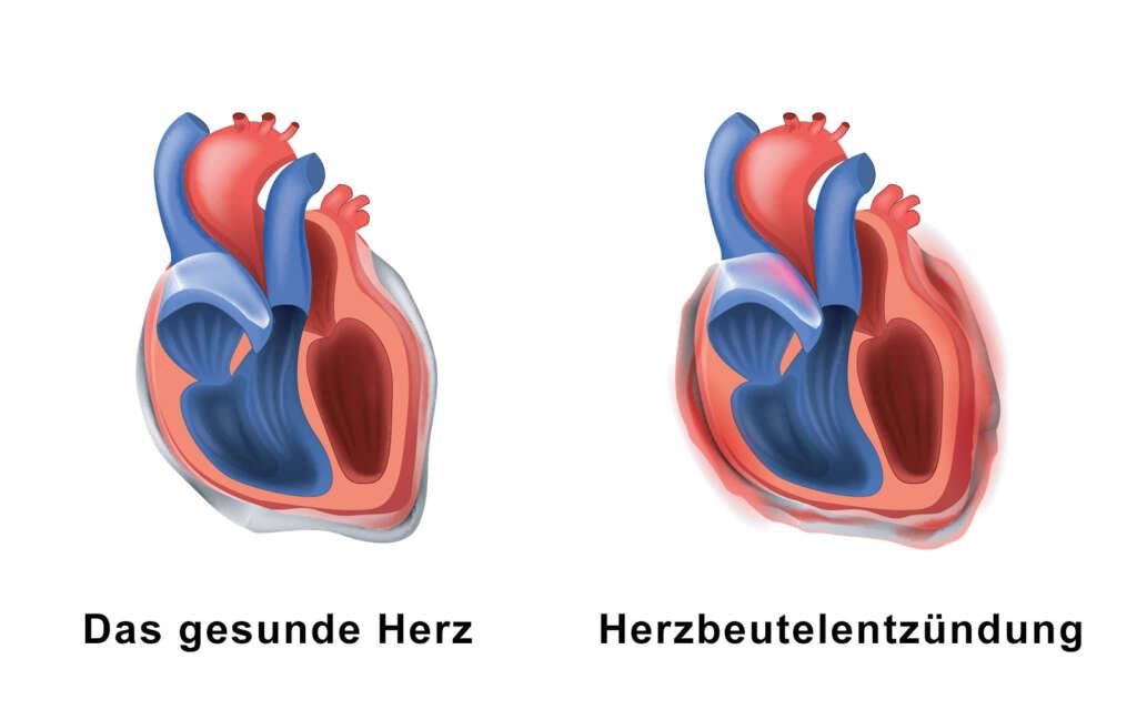 Herzbeutelentzündung pericarditis