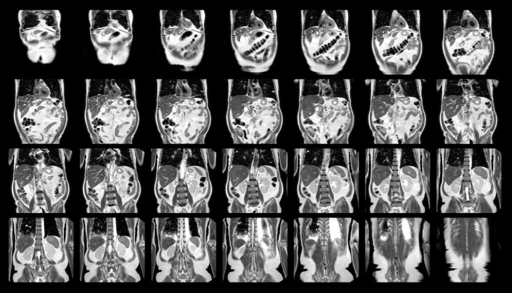 MRI Rektumkarzinom