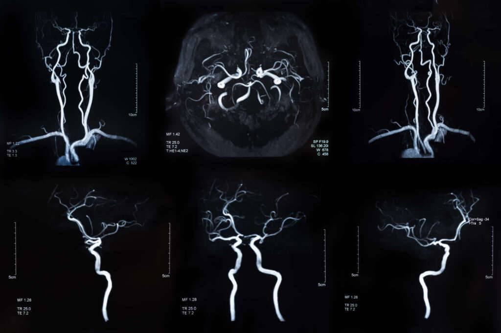 MRT Angiographie