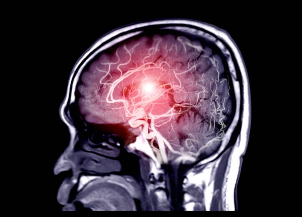 MRT Angiographie 2