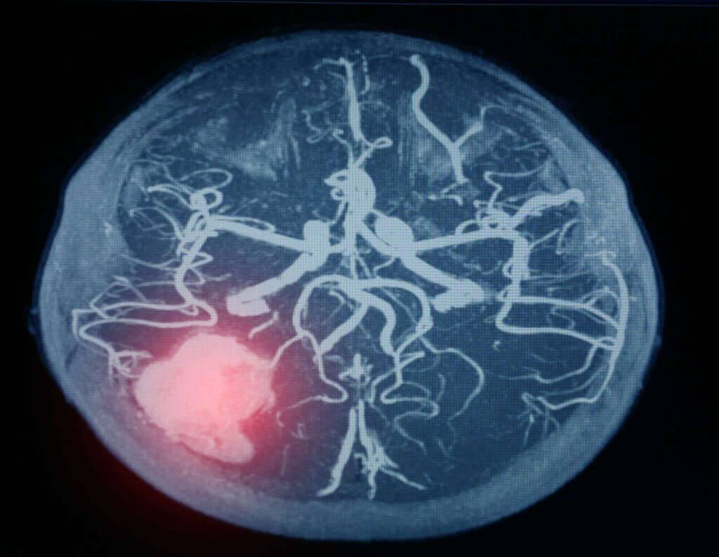 MRT Thrombose