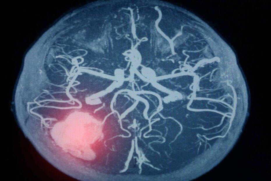 MRT Thrombose