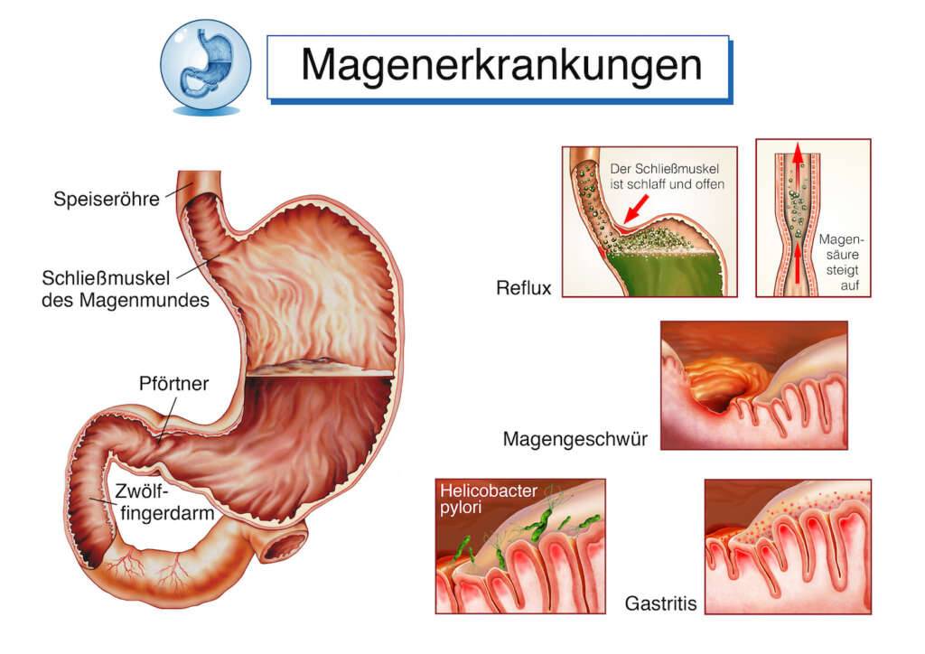 Magenerkrankungen