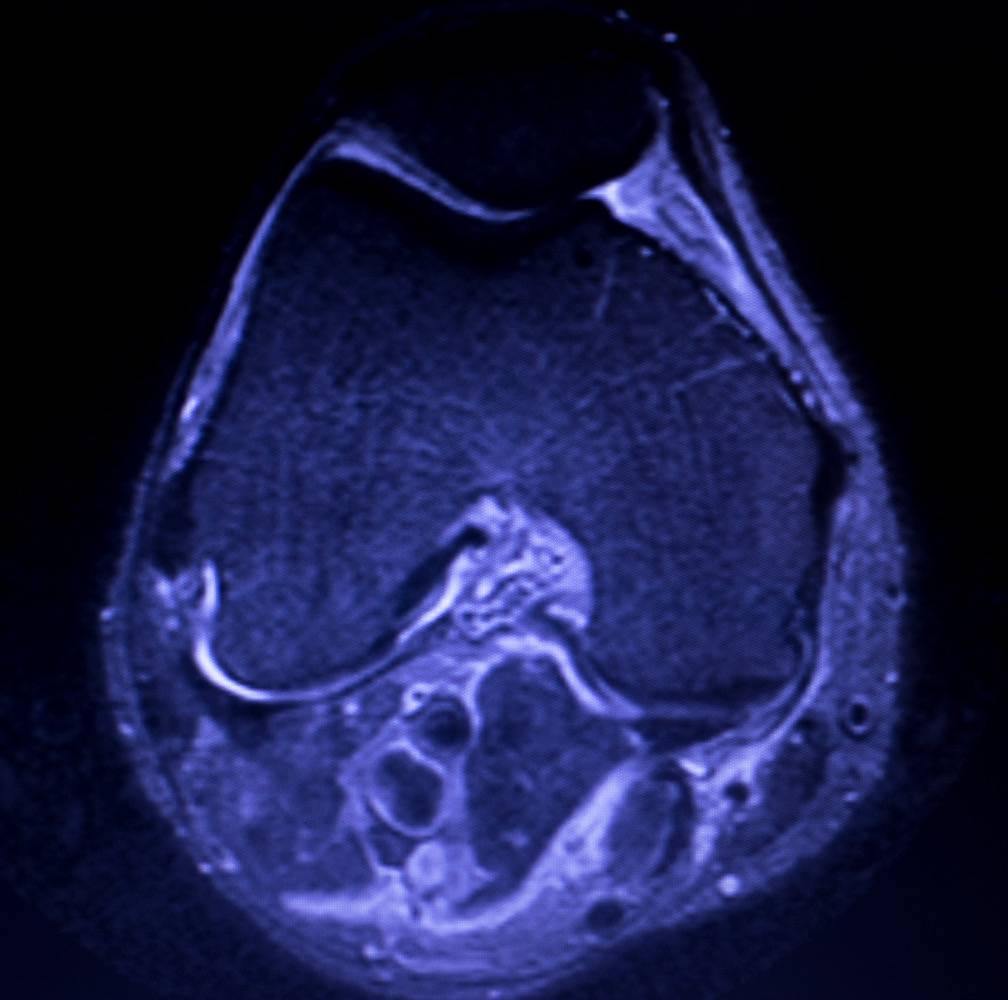 Meniskusriss MRT neu
