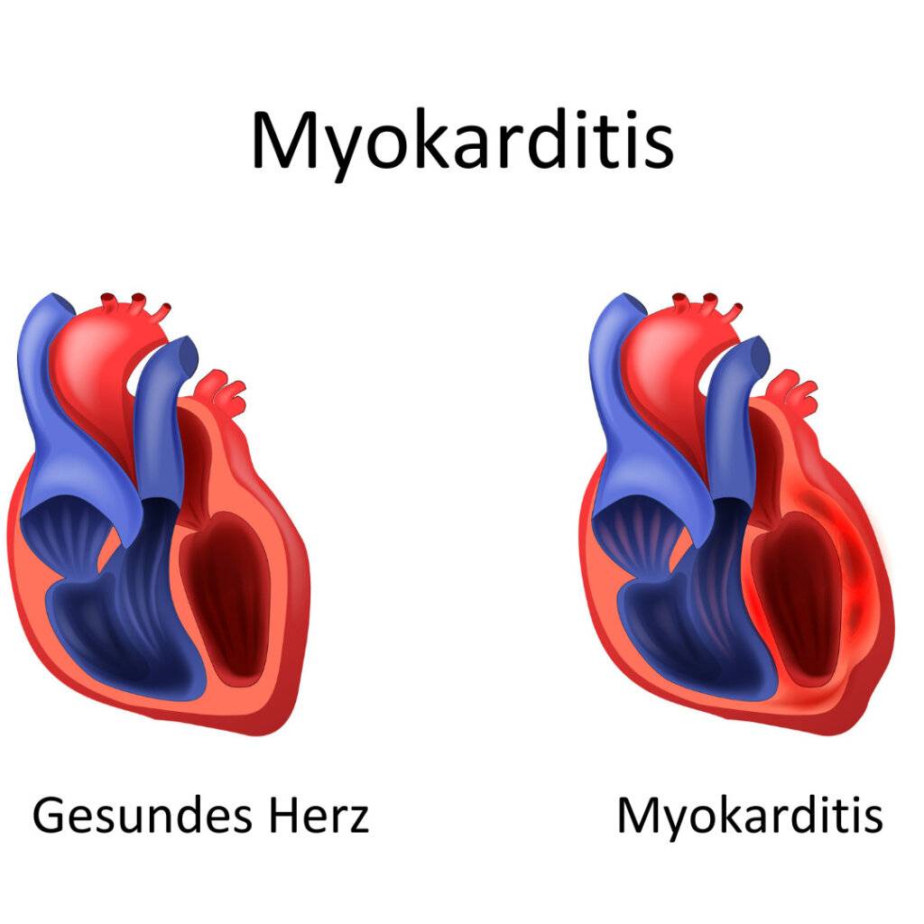 Herzmuskelentzündung