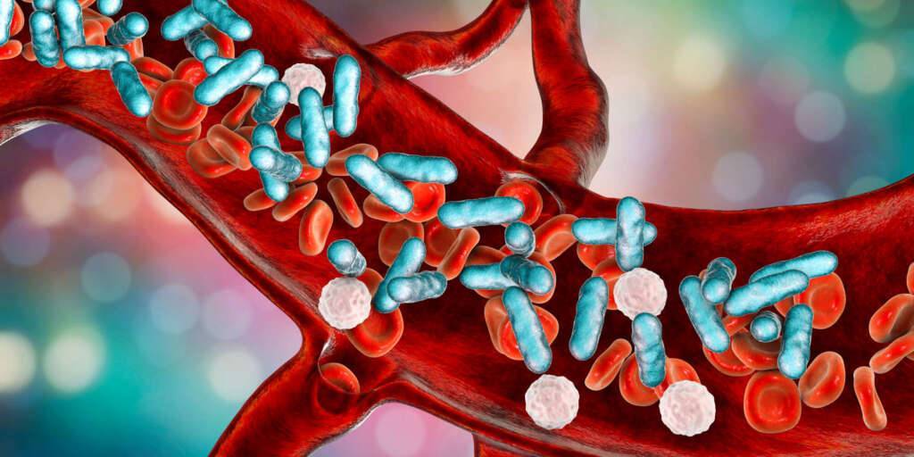 Sepsis