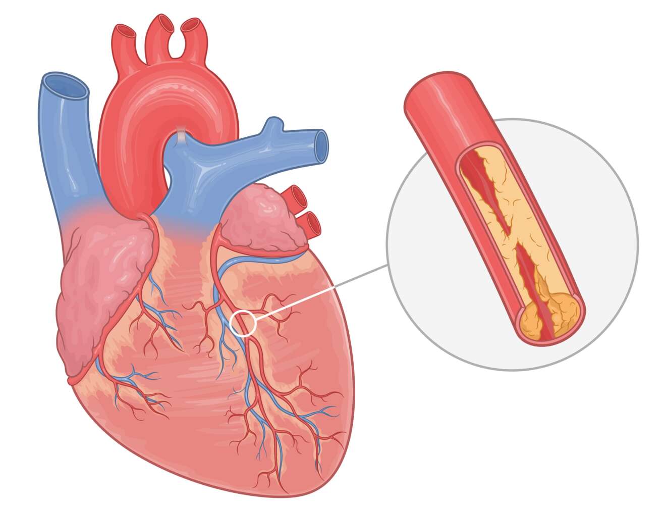 Angina Pectoris Ursachen und Behandlung