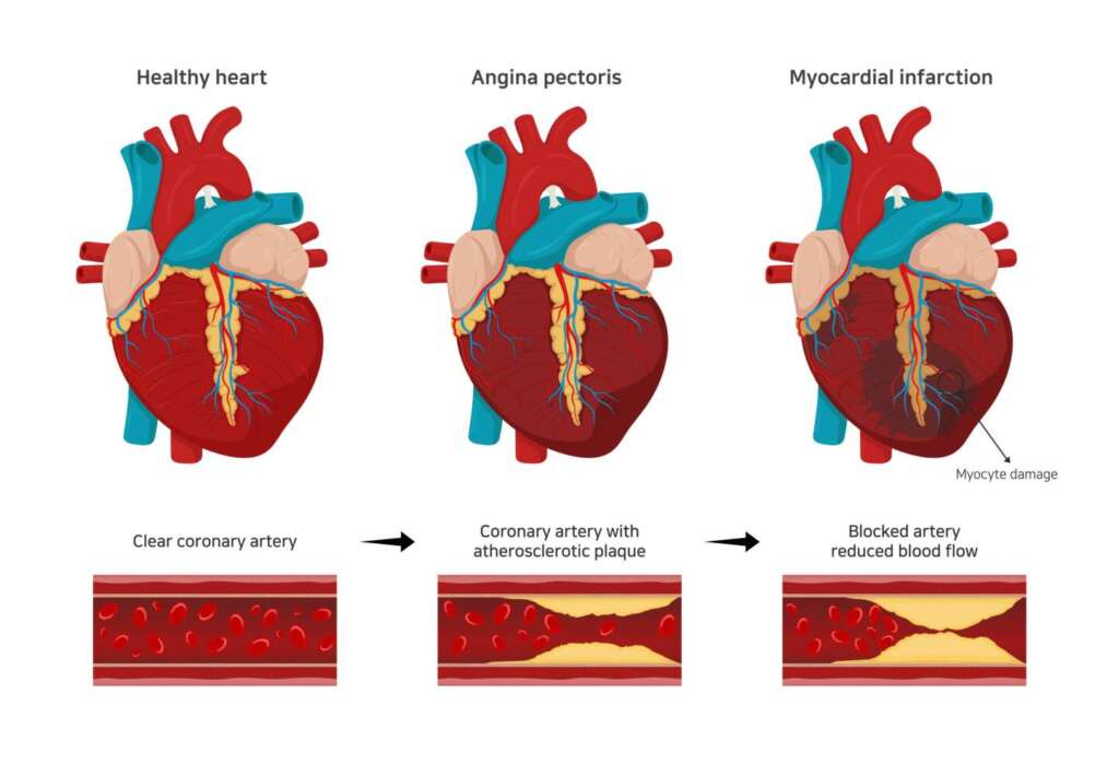 Angina pectoris