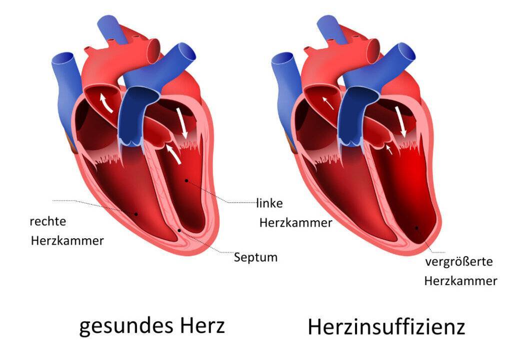 Herzinsuffizienz