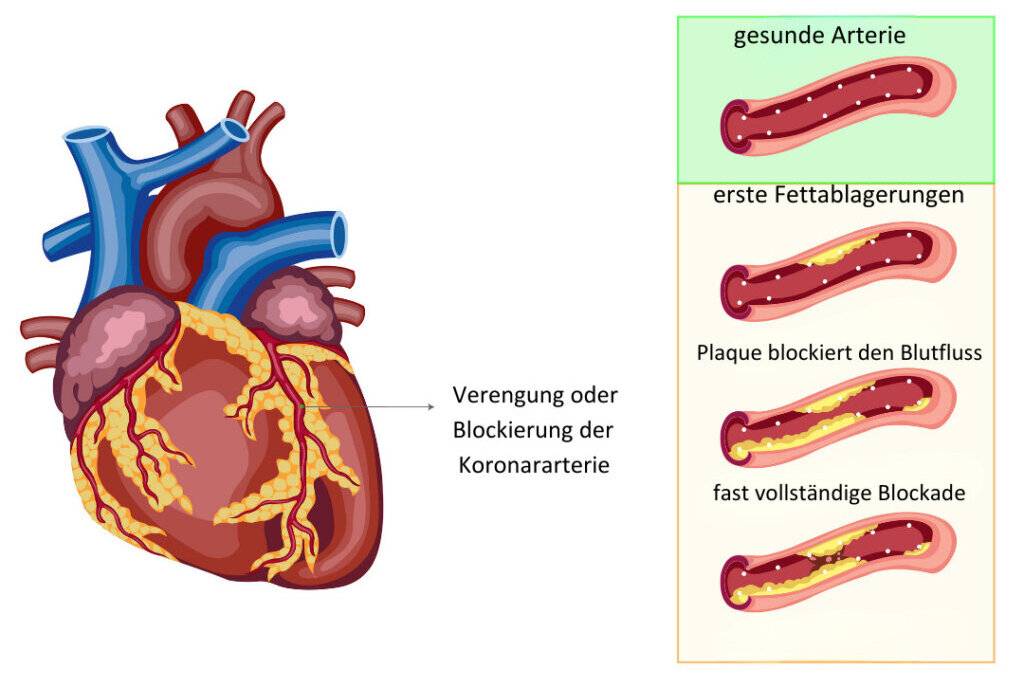 Koronare Herzerkrankung