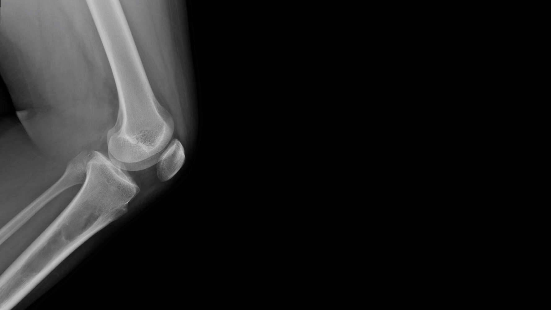 Film X ray knee radiograph show Fibrous dysplasia(FD) disease wh