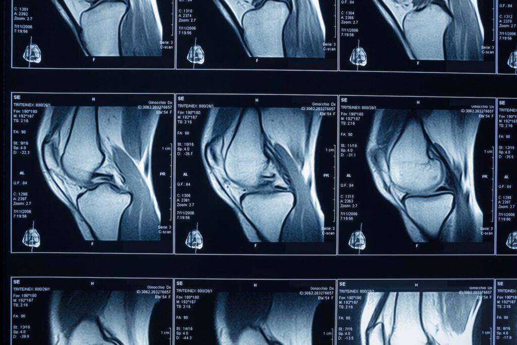 meniscus mri