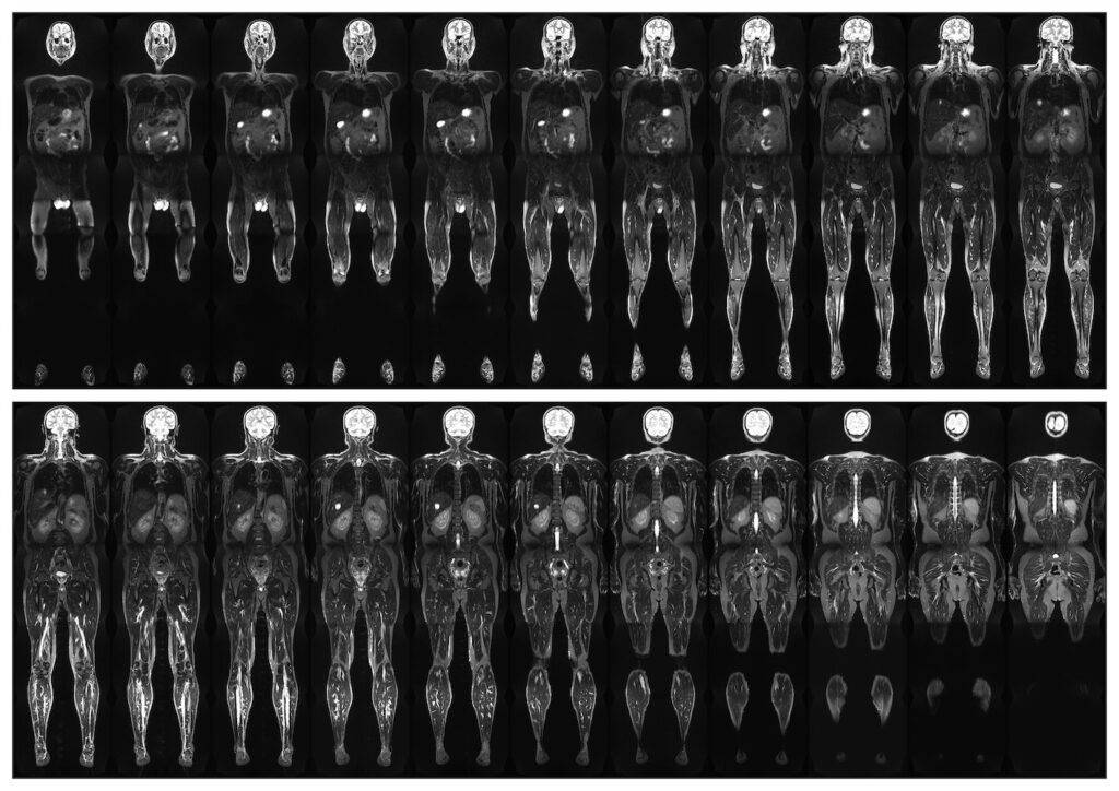 Ganzkörper MRT
