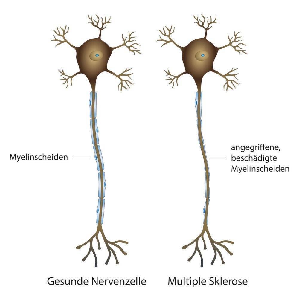 multiplesklerose nerven